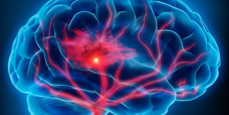 Brain Stroke Prediction